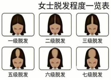 女生发缝正常标准图：一指宽算脱发！女生发缝宽怎么改善