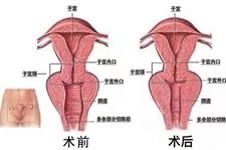 做完缩阴好后悔，分享90后女孩缩阴亲身经历