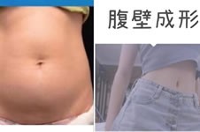 西安腹壁成形术崔鑫医生做的好吗，含前后对比恢复图片