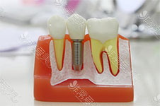 良心牙医平时不会告诉你的种植牙3个风险和常见后遗症
