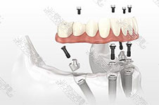 ​一些小品牌三万六种植全口牙敢信吗?满口种植牙要打几桩