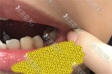 种植牙植骨粉惨痛经历:因为牙槽骨浅!植骨粉当晚开始疼！