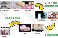种植牙流程及周期表分享:快看看种牙要多久可以种好！
