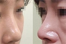 假体鼻子可以维持一辈子吗?鼻子做假体老了咋办?