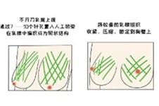 胸下垂松弛手术多少钱能矫正 提升收费按