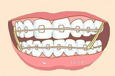 牙齿矫正牙套带几个月有变化 正畸过程的详细步骤流程讲解
