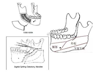 臉部磨骨手術(shù)一般多少價(jià)錢(qián)?親身經(jīng)歷分享磨骨瘦臉的費(fèi)用!