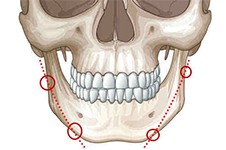 磨骨手術(shù)從哪里開刀口?帶你深入了解磨骨手術(shù)怎么進(jìn)行的!