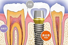 北京哪个医院做种植牙手术好？6000左右价格的有吗？