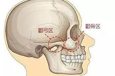 磨颧骨和颧骨内推哪个风险大?为什么说做了颧骨内推老得快?