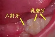 看过六龄牙刚刚萌出图片才知道,这些症状是六龄齿萌出征兆!