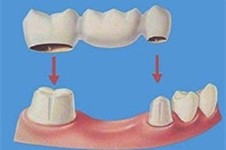 牙齿固定桥修复步骤过程详解,顺便告诉你牙齿做固定桥好吗!