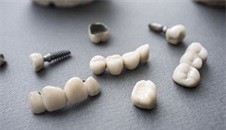 问答:种植牙牙冠怎么固定在基台上?基台装好几天能装牙冠?