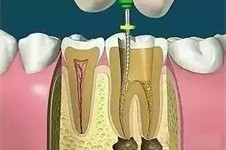 经验谈:重庆根管治疗多少钱一颗牙加牙冠?可以社保报销吗?