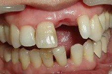 做种植牙和镶牙哪个好，推荐种牙是不是牙医想赚钱？