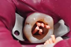 做过根管的牙能用几年，两年没戴牙套牙碎了！