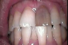 取出来的牙神经图片有多大，牙神经要抽几次才干净？