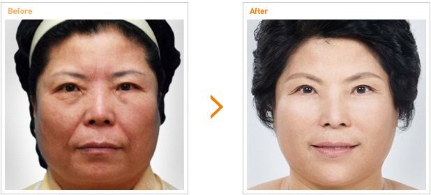 Anti-aging手术前后对比照片