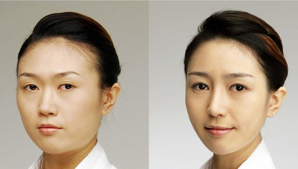 眼睛、鼻子、面部轮廓手术前后对比照片
