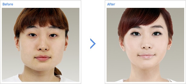 [高兰得整形外科]下颌角缩小手术（V脸型）前后照片