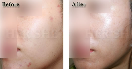 注射改善皮肤斑痕案例对比