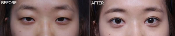双眼皮整形手术前后对比案例图
