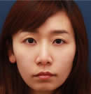 韩国赫尔希整形医院-全脸面部提升手术前后对比照片