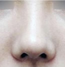 高兰得整形外科-韩国高兰得整形外科歪鼻修复手术前后对比照片