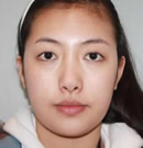 韩国赫尔希整形医院-瘦脸针瘦咬肌前后对比照片