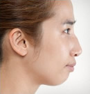 韩国高兰得驼峰鼻矫正、垫下巴手术前后对比照片