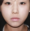 韩国赫尔希整形医院-面部激光脂肪雕塑术前后对比照片