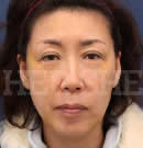 韩国赫尔希整形医院-面部提升除皱术前后对比照片