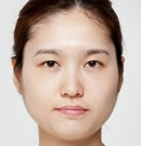 韩国高兰得开眼角和双眼皮整形手术前后对比照片_术前