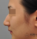 韩国丽珍整形医院-鹰钩鼻矫正手术对比案例