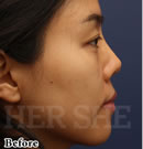 鼻部综合整形对比案例_术前