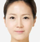 高兰得整形外科-韩国高兰得埋线法双眼皮整形手术前后对比照片