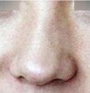 韩国高兰得整形外科歪鼻修复手术前后对比照片_术前