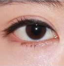 韩国赫尔希整形医院-韩式双眼皮手术前后对比照片