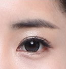 韩国高兰得整形外科眼睛修复手术前后对比照片_术后