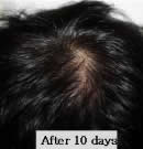 韩国赫尔希整形医院-头发移植术前后对比照片