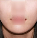 韩国赫尔希整形医院-注射瘦脸前后对比照片
