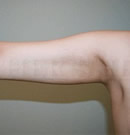 韩国赫尔希整形医院-手臂吸脂术前后对比照片