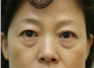 韩国艺德雅由于眼下脂肪再配置手术无复发手术案例