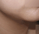 韩国赫尔希整形医院-Accusculpt -去除皱起的双下巴