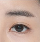 韩国高兰得整形外科眼睛修复手术前后对比照片