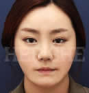 韩国赫尔希整形医院-面部轮廓整形术前后对比照片