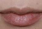 韩国赫尔希整形医院-更加精致的女性嘴唇