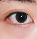 韩国赫尔希整形医院-矫正双眼皮术前后对比照片