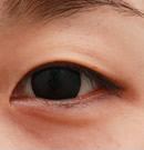 韩国赫尔希整形医院-埋线法双眼皮手术前后对比照片