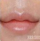 韩国赫尔希整形医院-注射丰唇整形前后对比照片